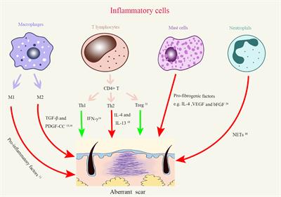 The Roles of Inflammation in Keloid and Hypertrophic Scars